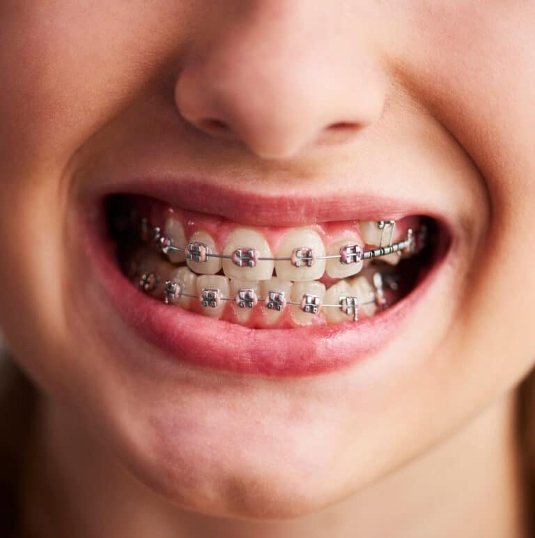 Effective Braces Cleaning Tips from Dentist Dr. Debra Brown