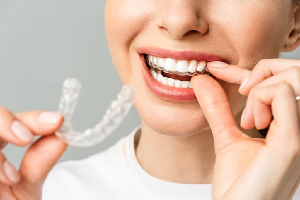 Mackay Invisalign