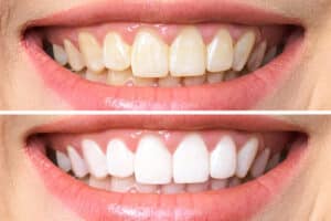 Teeth Whitening - My Dentist Mackay