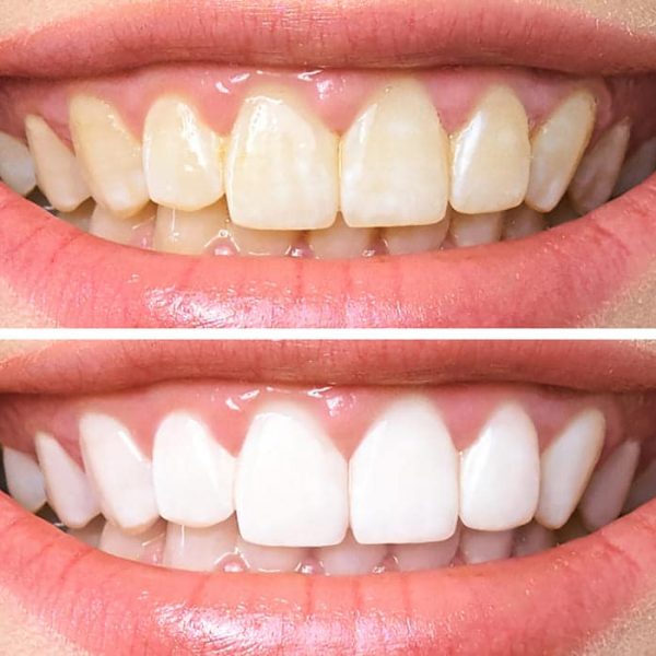 Discoloured Teeth