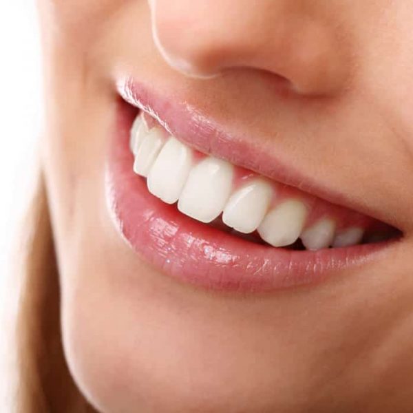 Professional Teeth Whitening Mackay