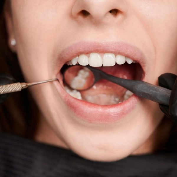 Root Canal Treatment Mackay