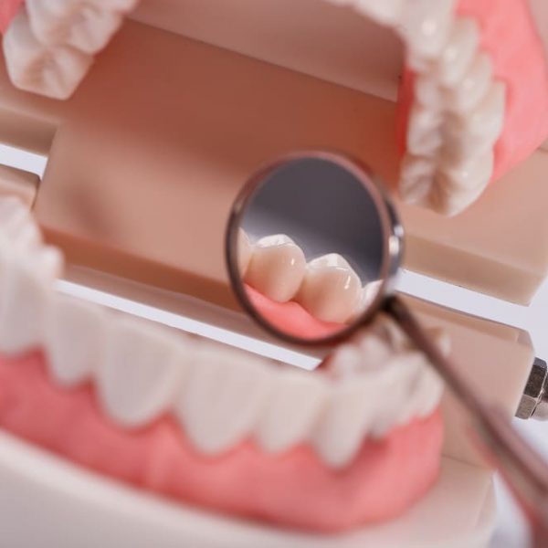 Root Canal Treatment